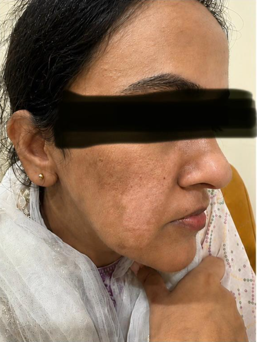 Vitiligo Treatment Before