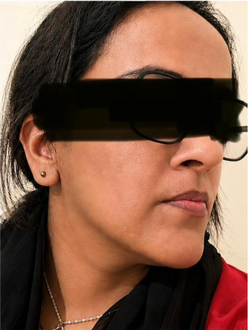 Vitiligo Treatment After