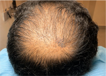 Scalp Micropigmentation Before