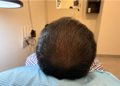 Scalp Micropigmentation After
