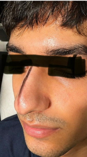 Non-Surgical Rhinoplasty Before