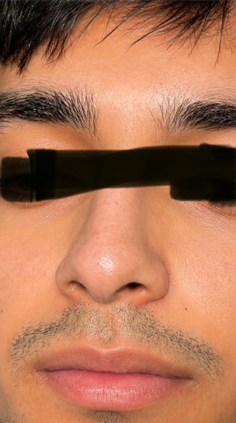 Non-Surgical Rhinoplasty After