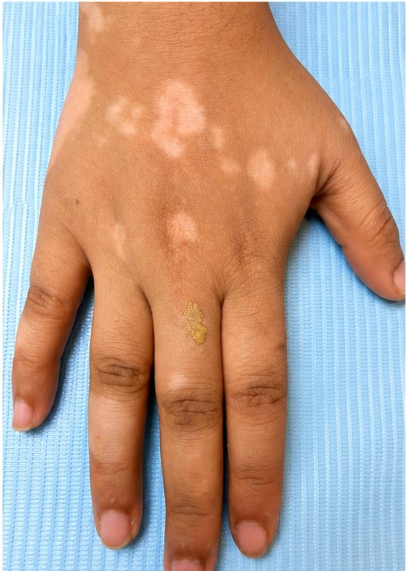 Vitiligo Camouflage Before
