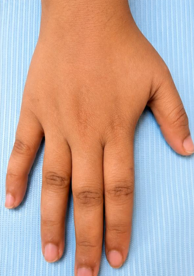 Vitiligo Camouflage After