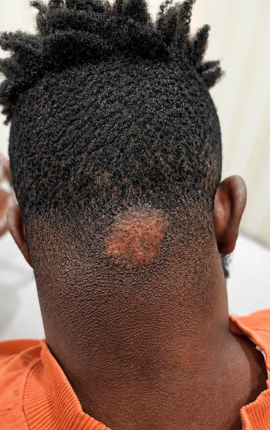 Acne Keloidalis Nuchae After